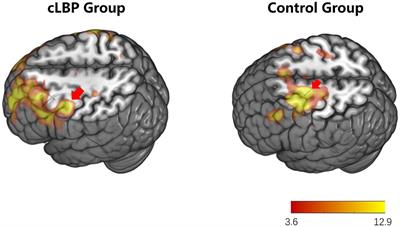 Research on the multidimensional brain remodeling mechanisms at the level of brain regions, circuits, and networks in patients with chronic lower back pain caused by lumbar disk herniation